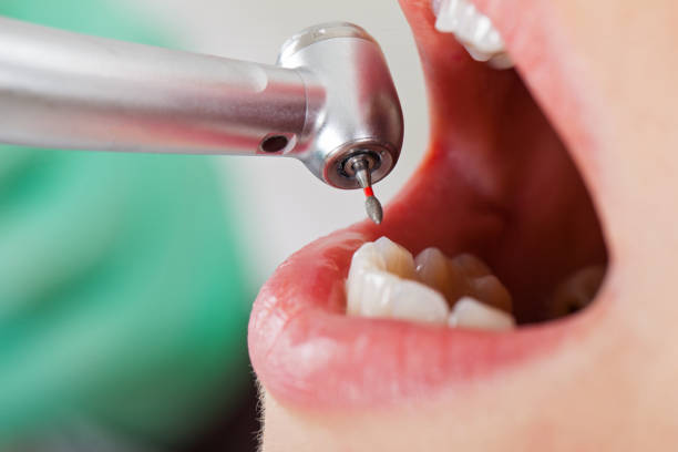 Best Dentist for Tooth Abscess  in Vineyards, FL